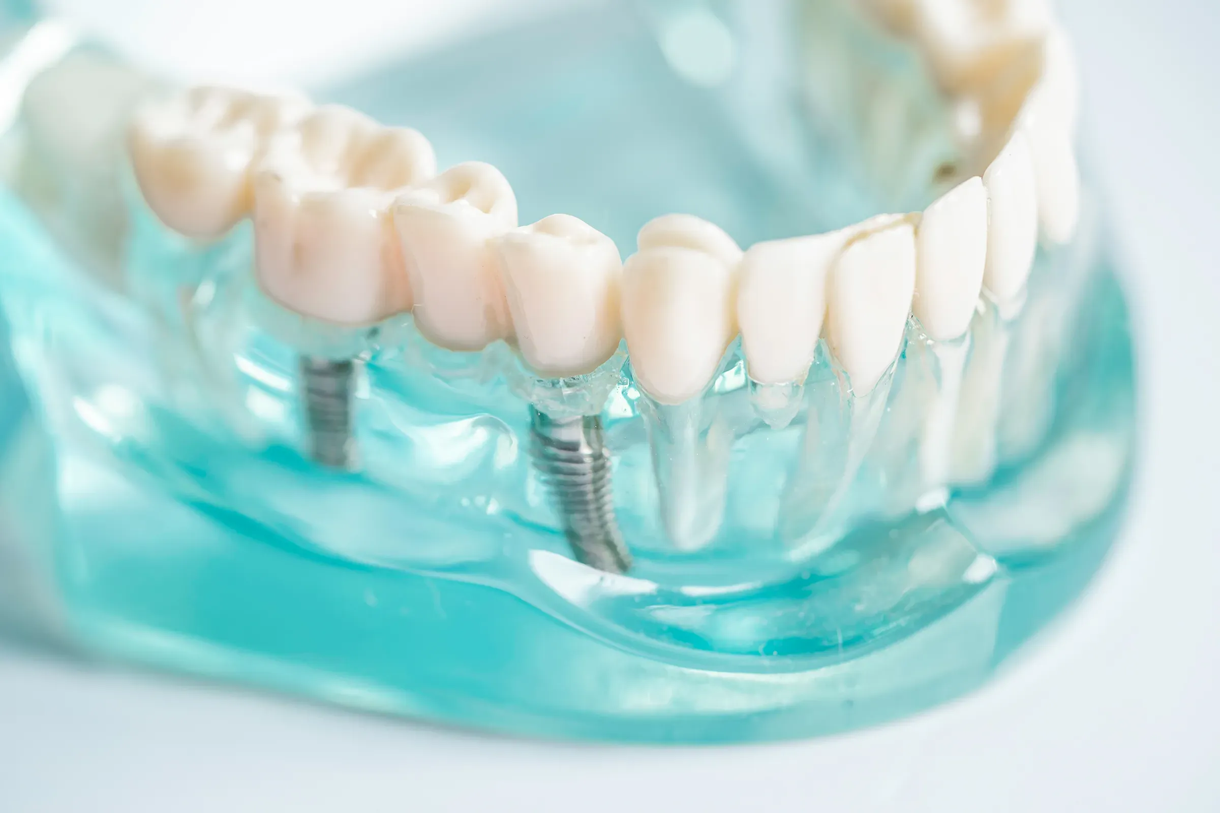 Dental implants in Mannheim | Consultation and costs