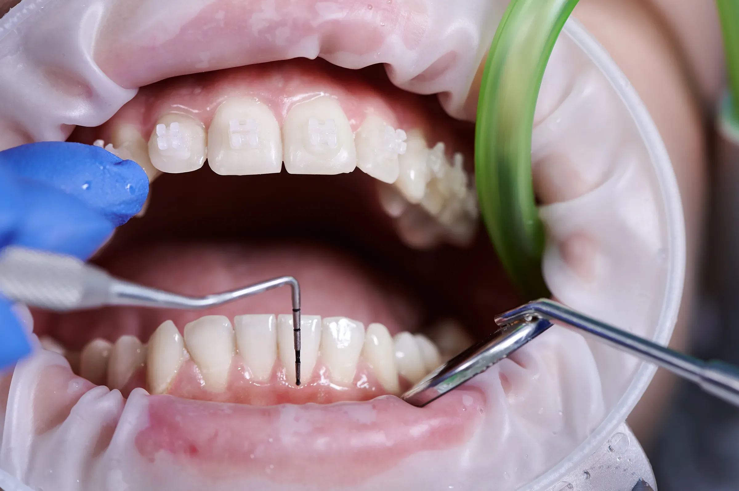 Periodontics in Mannheim | Specialist for healthy gums