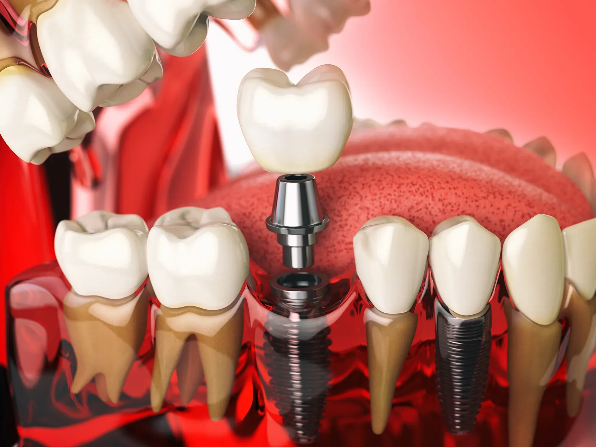 Dentures that stay put